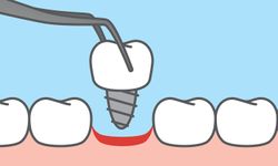 “รากฟันเทียม” คืออะไร? ช่วยแก้ไขปัญหาฟันได้อย่างไรบ้าง?