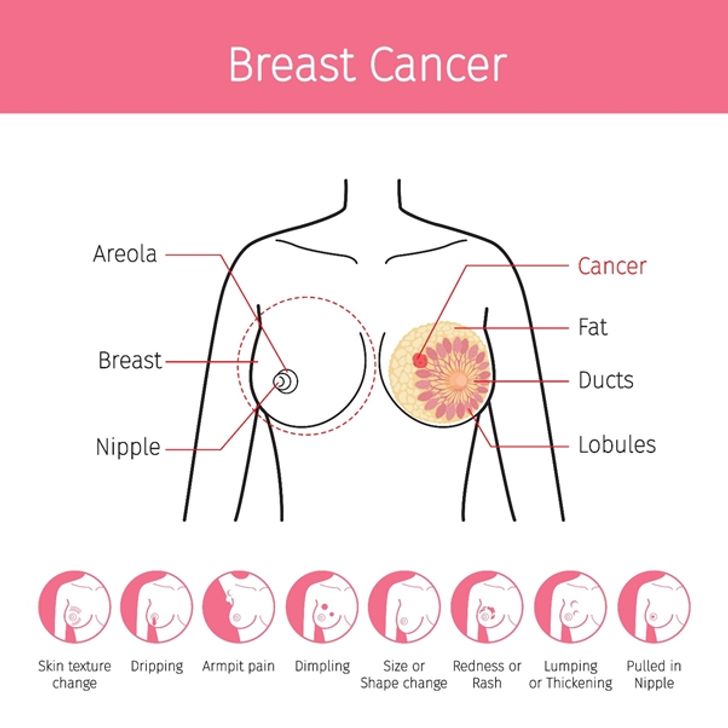 breast-cancer