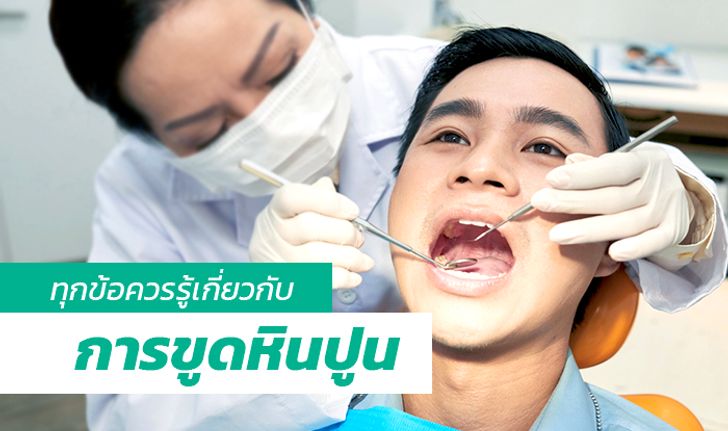 ทุกข้อควรรู้เกี่ยวกับการขูดหินปูน