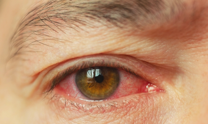 5 วิธีป้องกัน “ตาแดง” โรคระบาดหน้าฝน