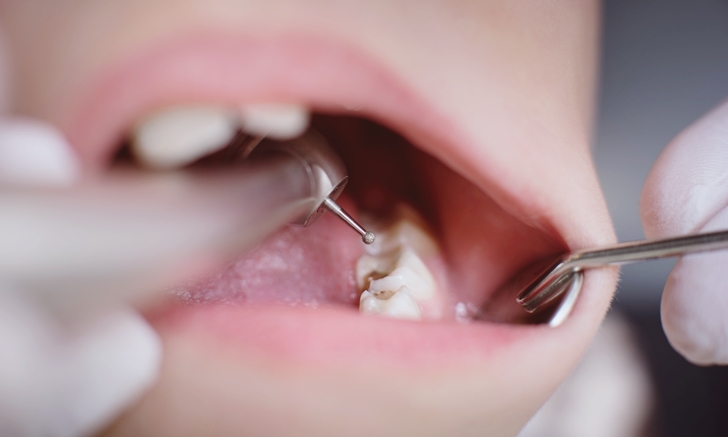 "ฟันผุ" กับเรื่องเข้าใจผิดที่อาจทำให้ฟันแย่กว่าเดิม