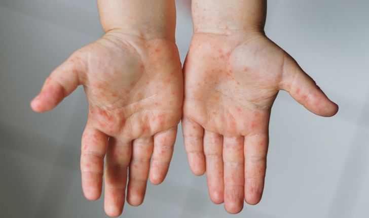 โรค "มือ เท้า ปาก" โรคติดต่อในเด็กที่พบได้หลังเปิดเทอม