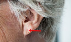 “รอยย่นที่ติ่งหู” สัญญาณเสี่ยงโรคอันตราย