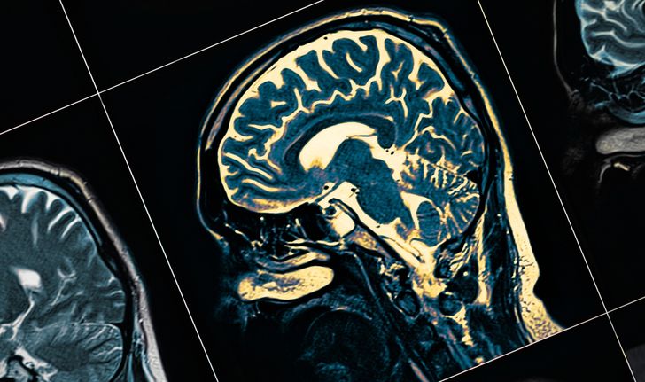 “สมองเสื่อม” ไม่เหมือน “อัลไซเมอร์” และสิ่งอื่นๆ ที่คนมักเข้าใจผิด