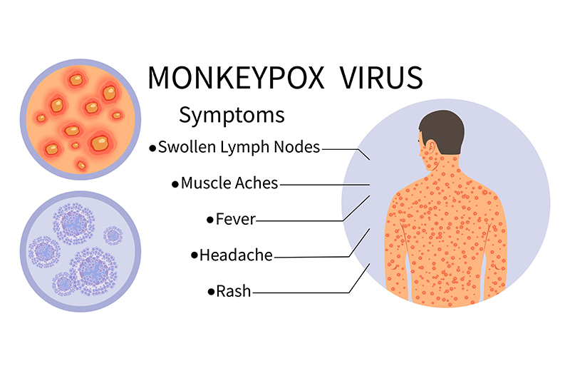 ฝีดาษลิง Monkey Pox