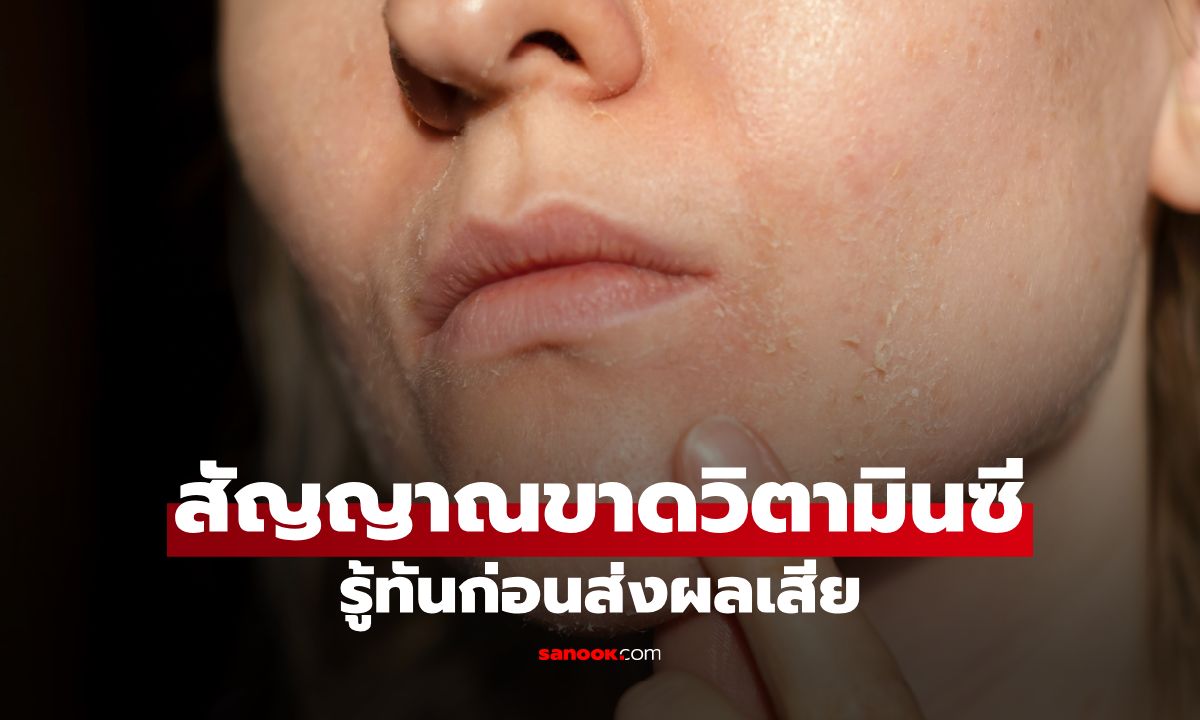 สัญญาณขาดวิตามินซี รู้ทันก่อนส่งผลเสียต่อร่างกาย