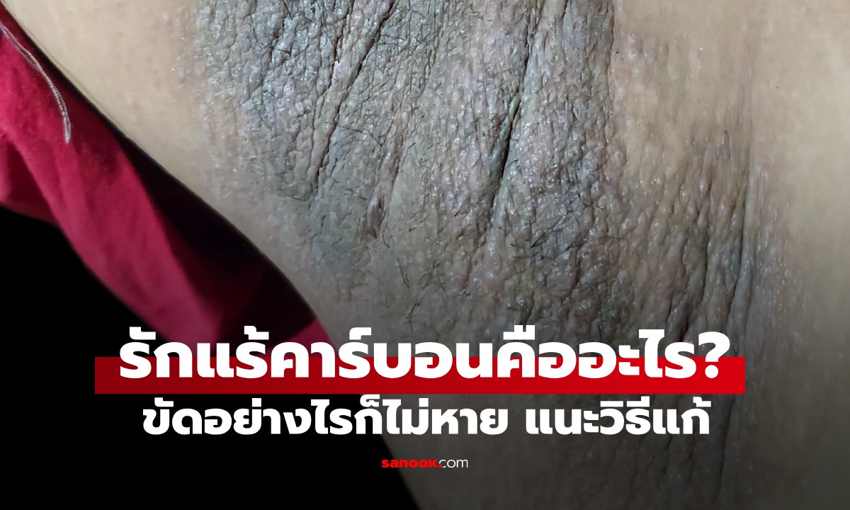 "รักแร้คาร์บอน" เกิดจากอะไร? ขัดให้ตายก็ไม่ออก แนะวิธีแก้ฟรีๆ ให้หาย