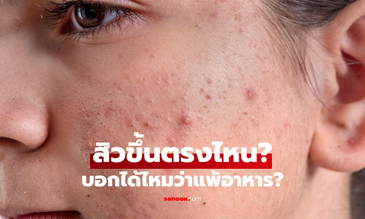 ภาพสิวขึ้นตรงไหน บอกได้ไหมว่าแพ้อาหาร? ไขคำตอบที่หลายคนเข้าใจผิด พร้อมเช็กจุดเสี่ยงบนใบหน้า