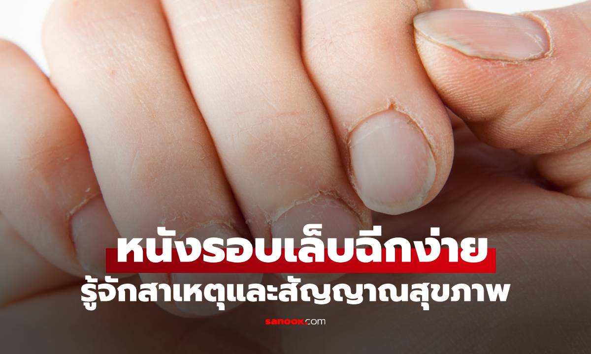 หนังรอบเล็บฉีกง่าย เกิดจากอะไร? รู้จักสาเหตุและสัญญาณสุขภาพที่ควรสังเกต