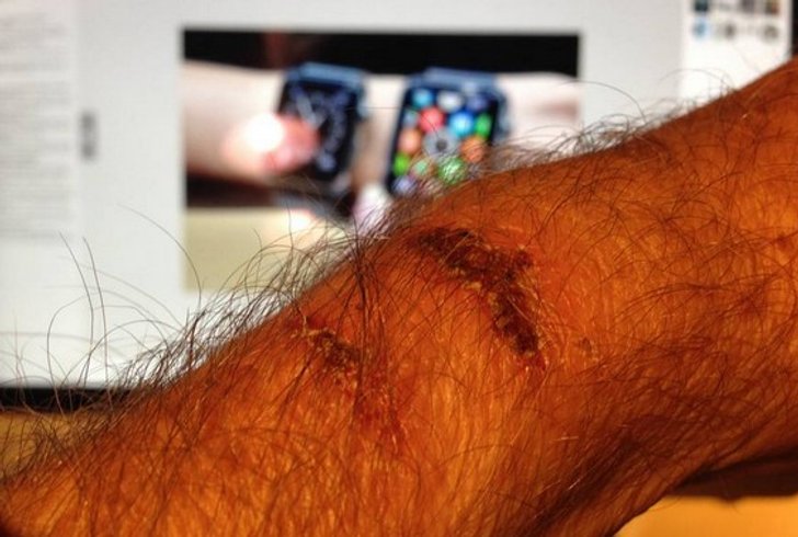 เป็นงง? ผู้ใช้ โวย Apple Watch ร้อนมากจนเป็นแผลไหม้ที่ข้อมือ