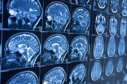 ข่าวดี ทีมวิจัยอิตาลีพัฒนา AI วินิจฉัยโรคอัลไซเมอร์ล่วงหน้าได้ถึง 10 ปี