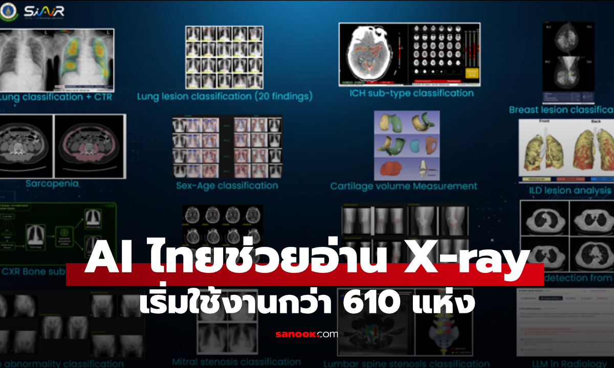 ศิริราชพัฒนา AI ช่วยอ่าน X-ray ขยายใช้แล้วกว่า 610 โรงพยาบาล
