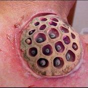 trypophobia โรคกลัวรู คำฮิตในโลกโซเชียล