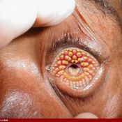 trypophobia โรคกลัวรู คำฮิตในโลกโซเชียล