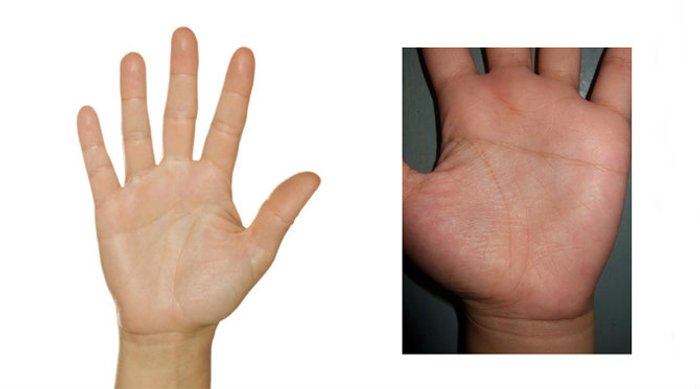 จริงหรือไม่ "เส้นลายมือขาด" จะตายโหง?