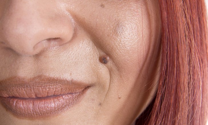 .ตำแหน่งไฝ ขี้แมลงวัน บนใบหน้า จุดไหนดี มีเสน่ห์ มีวาสนา.