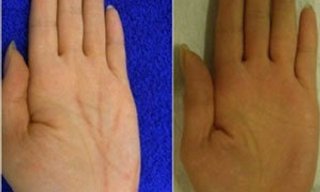 ชาวญี่ปุ่นเชื่อศัลยกรรม "กรีดเส้นลายมือใหม่ เปลี่ยนชีวิต"