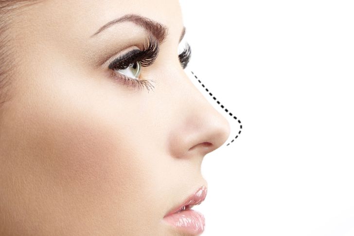 Rhinoplasty (Nose Surgery)