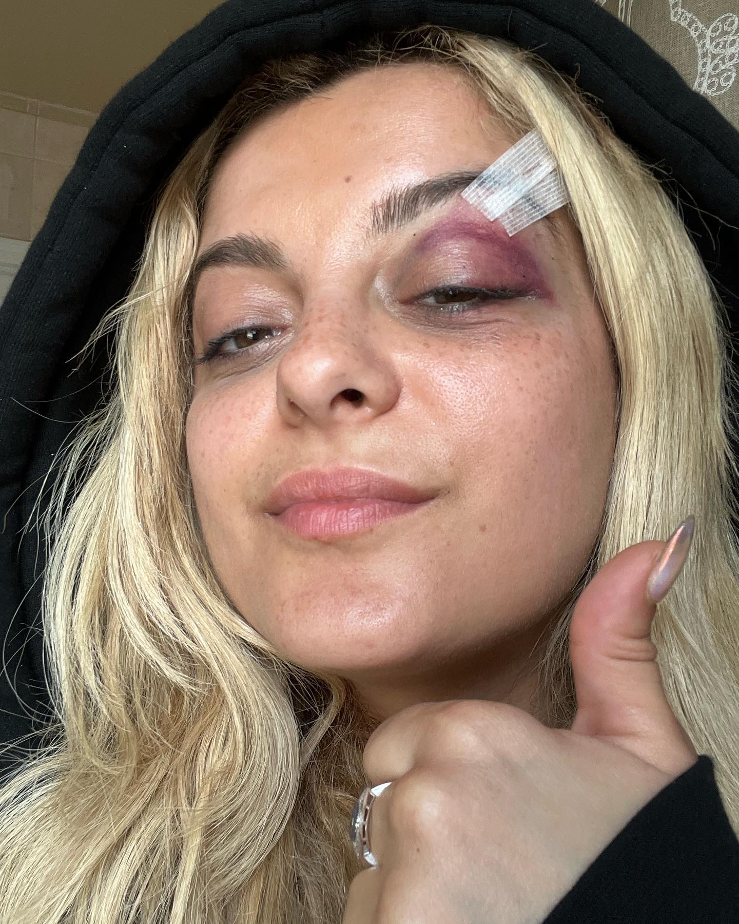 Bebe Rexha bruises