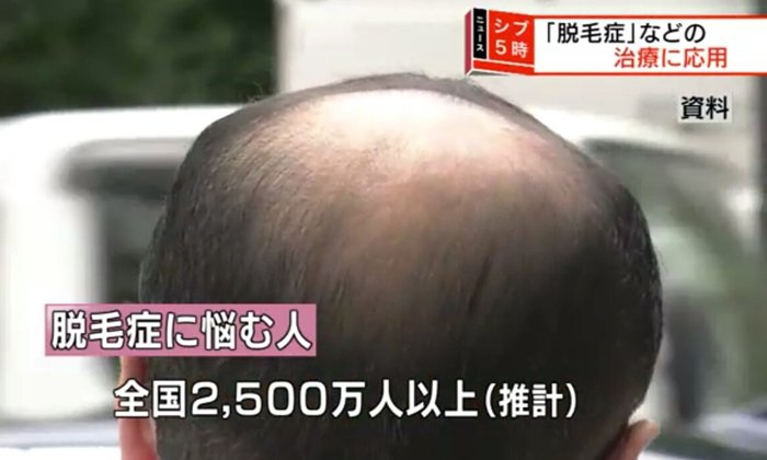 ปลูกผม 10,000 เส้นใน 20 วัน! สถาบัน RIKEN แห่งญี่ปุ่นกับนวัตกรรมใหม่สำหรับคนหัวล้าน