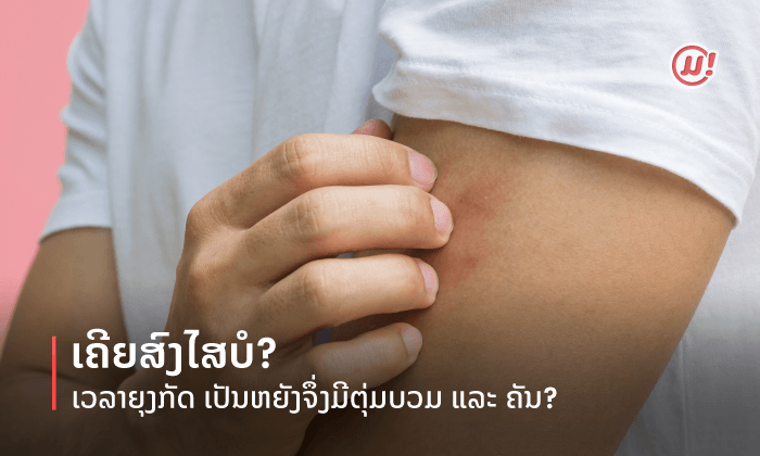 ເຄີຍສົງໄສບໍ? ເວລາຍຸງກັດ ເປັນຫຍັງຈຶ່ງມີຕຸ່ມບວມ ແລະ ຄັນ?