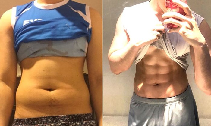รีวิวเปลี่ยนพุง เป็น Six Pack ด้วยวิธีศัลยกรรม