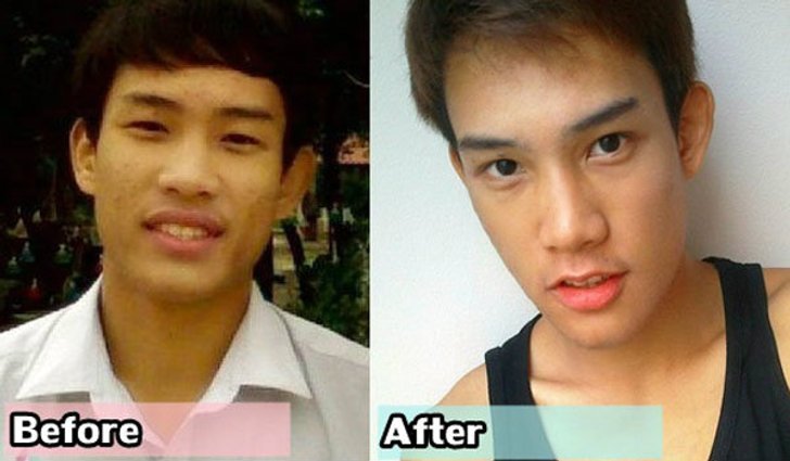 หล่อขึ้นได้ ด้วย ศัลยกรรม ปากบาง