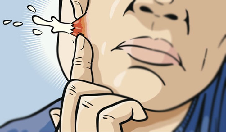 5 ความเชื่อผิดๆเกี่ยวกับ′สิว′