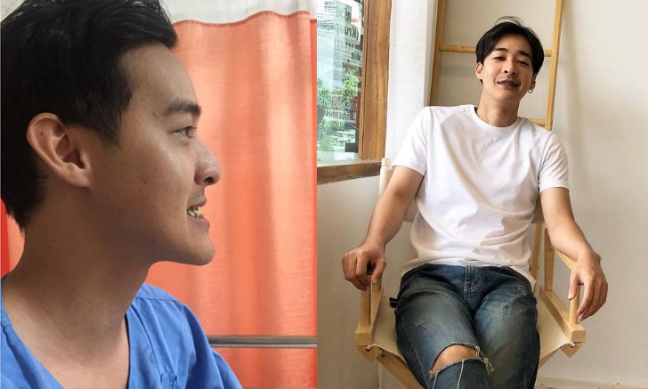 หล่อมาก 1 ปีผ่านไป "หม่อมเอ็ม" หลังผ่าตัดขากรรไกรแก้ไขฟันกรามล่างยื่น