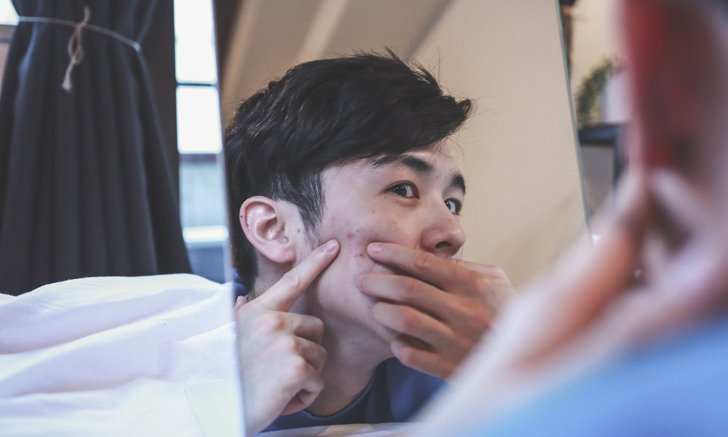 ความสัมพันธ์ระหว่าง “การดื่มนม” กับ “การเกิดสิว”