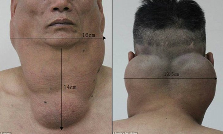ชายจีนดวด “เหล้าขาว” 30 ปี “เนื้องอก” พอกรอบคอ