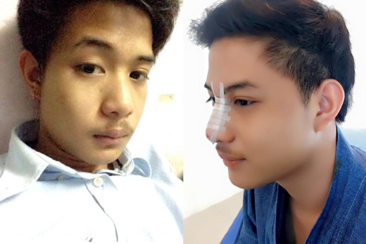 แจ็ค ธนพล อดีตแฟน แพท ณปภา เสริมจมูก หล่อเฟี้ยวขึ้นเยอะ