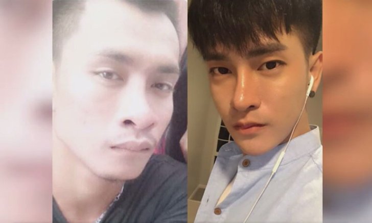 แชร์ประสบการณ์ “มินโฮ” หนุ่มศัลยกรรม 29 ครั้ง เกือบตาบอดเพราะหมอเถื่อน