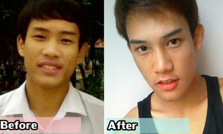 หล่อขึ้นได้ ด้วย ศัลยกรรม ปากบาง