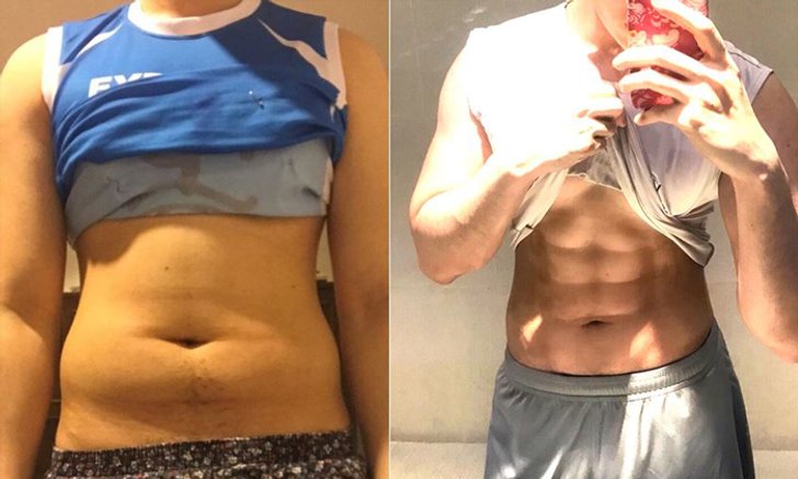 รีวิวเปลี่ยนพุง เป็น Six Pack ด้วยวิธีศัลยกรรม