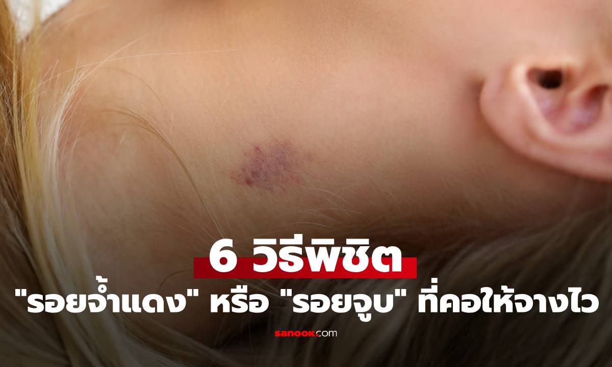 6 วิธีพิชิต "รอยจ้ำแดง" หรือ "รอยจูบ" ที่คอให้จางไว ทันใจไม่อายใคร