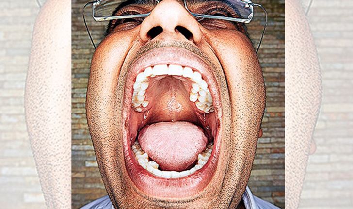 หนุ่มอินเดีย"ฟันเยอะที่สุดในโลก" มีฟันเต็มปากถึง 37 ซี่!!