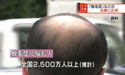 บอกลาศีรษะล้าน! สถาบัน RIKEN คิดนวัตกรรมใหม่ ปลูกผม 10,000 เส้นใน 20 วัน