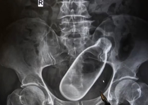 ยัดขวดเข้าทวาร