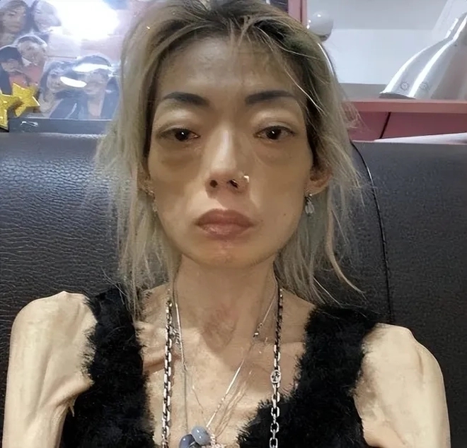 ดราม่าชีวิต อดีตนางแบบดัง ลดน้ำหนักเหลือแค่ 22 กก.