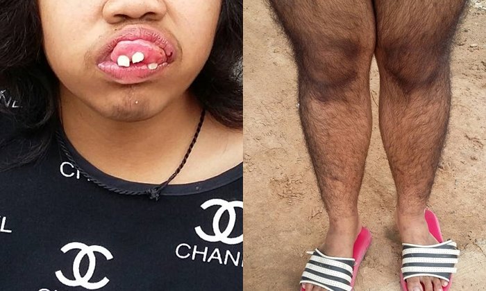 น้องปอ เด็กกำพร้าวัย 12 ปี เหงือก-ฟัน ยื่นออกจากปาก ขนขึ้นเต็มตัว
