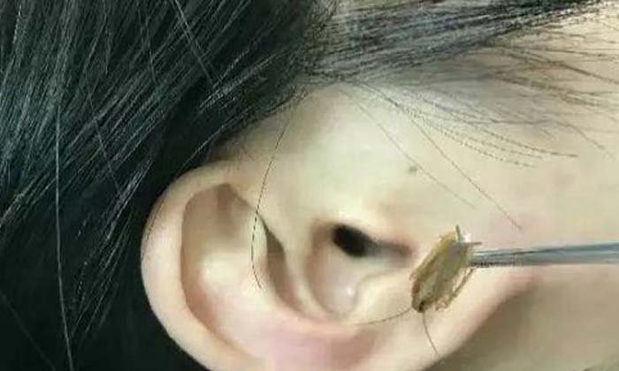 อึ้งเลย! สาวจีนนอนหลับได้ยินเสียงดังในหู หมอตรวจเจอ "แมลงสาบ"