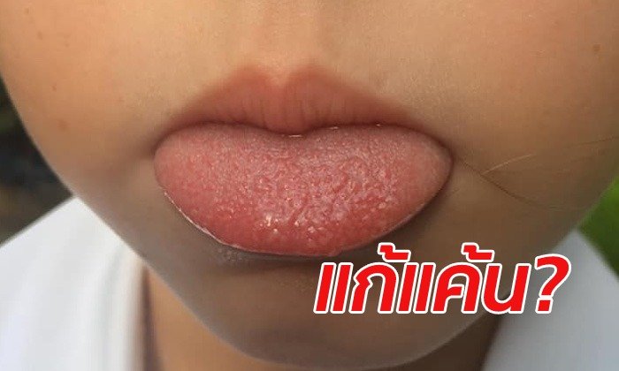 คุณแม่ช็อก! ลูก 7 ขวบ ถูกเพื่อนแกล้งสารพัด ล่าสุดหลอกให้ดื่มน้ำร้อน