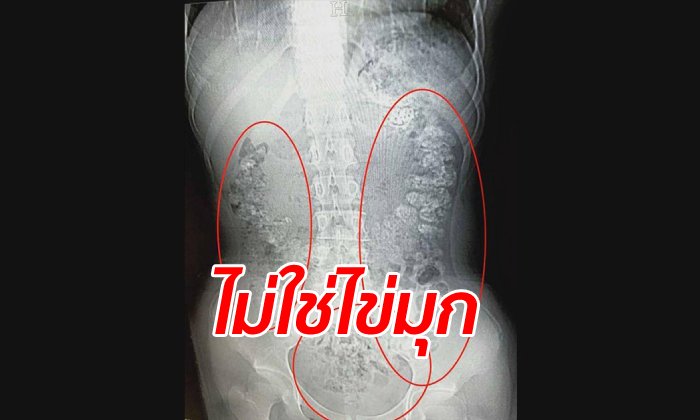 แพทย์รามาฯ แจงภาพเอกซเรย์ "ไข่มุก" อืดเต็มท้องเด็กจีน แท้จริงอาจเป็น "อุจจาระ"