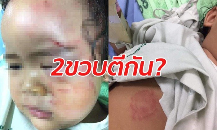 ครอบครัวช็อก! เด็ก 2 ขวบถูกเพื่อนรุมทำร้ายที่โรงเรียน หน้าบวม-แผลเต็มตัว