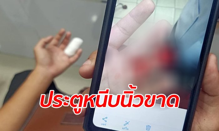 หนุ่มวัย 18 เคราะห์ร้าย กระเป๋ารีบไล่ลงป้าย ประตูรถเมล์หนีบนิ้วขาดหายไป 1 ข้อ