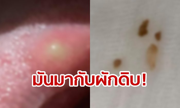 ผู้โพสต์ระทึก เจอพยาธิตืดหมูฝังตัวอ่อนในลิ้น ที่แท้มากับผักดิบ บทเรียนอาหารคลีนต้องสะอาด!