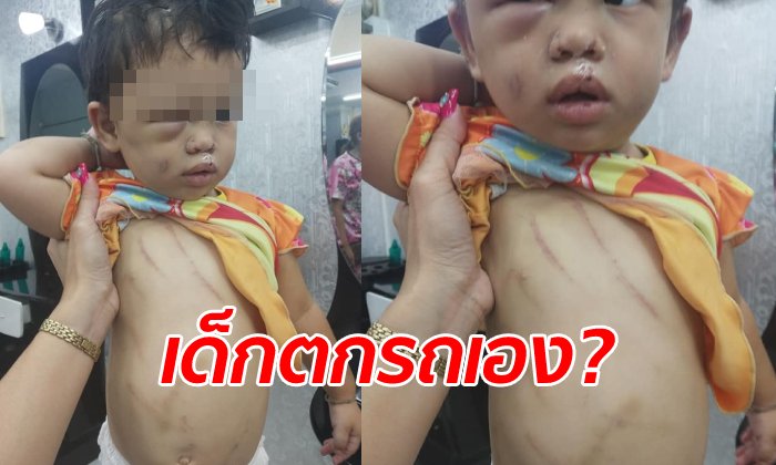 แม่จ้างคนรู้จักเลี้ยงลูกสาววัย 1 ขวบ ช็อกเจอสภาพตาบวมปูด รอยแผลน่วมทั้งตัว