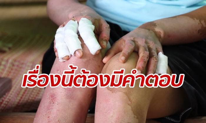 ผู้ว่าฯ ขอนแก่นลั่นชัด เด็ก ม.6 ทำงานวิทย์ฯ ถูกไฟลวก ต้องมีคำตอบ