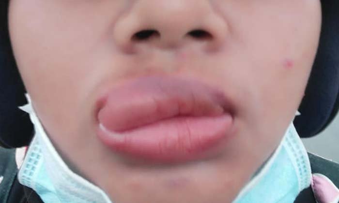 สาวโพสต์เตือนภัย กุ้งต้มเค็ม ทำปากเบี้ยวบวมเป่ง พูดไม่ได้